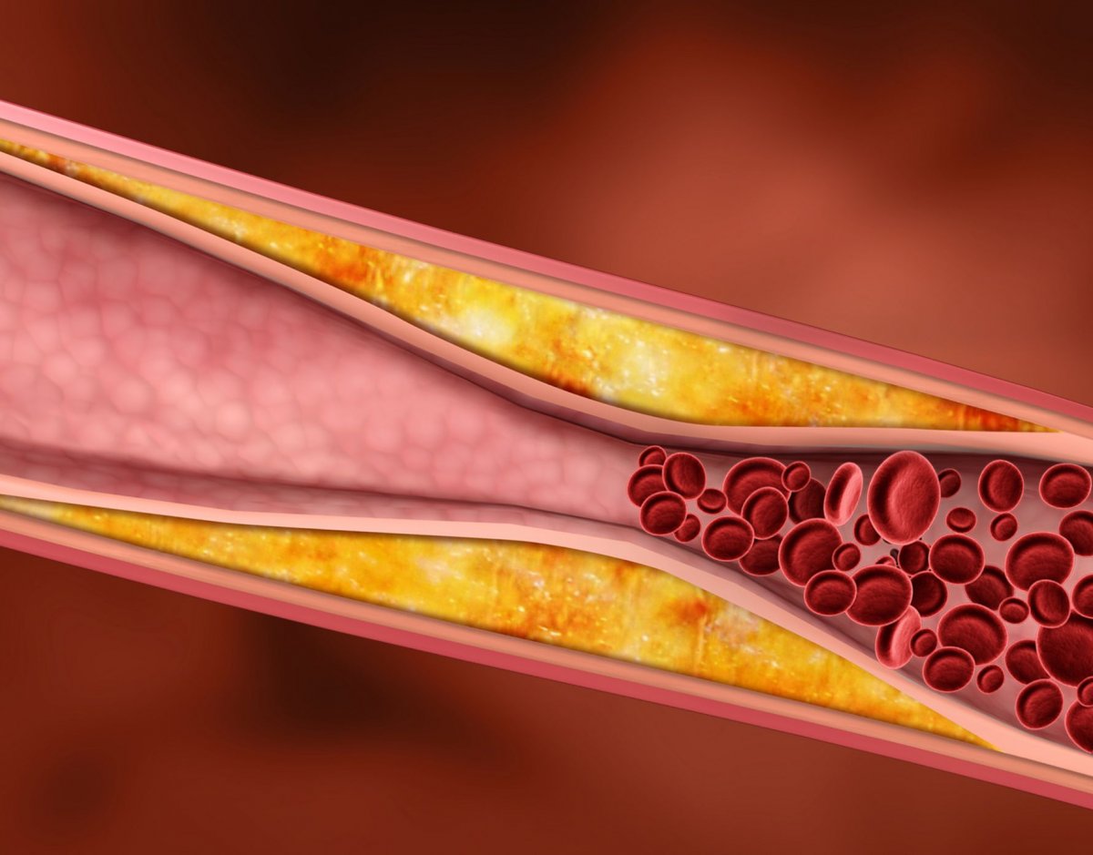 Повышенный холестерин сосуды