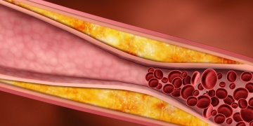 Desatero proti vysokému cholesterolu